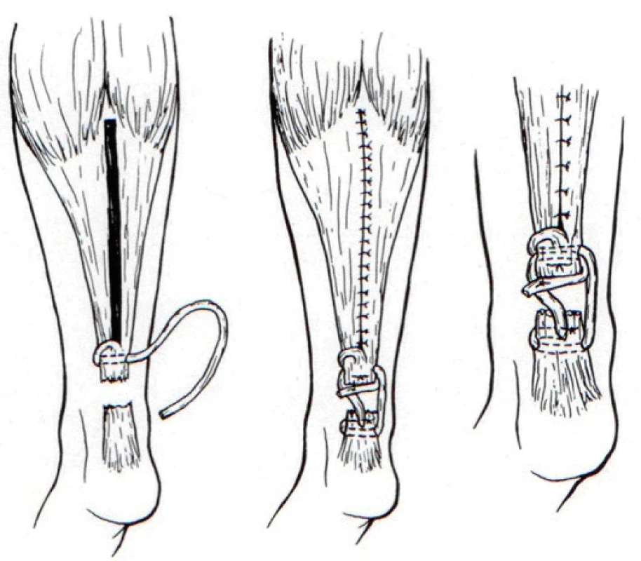 Plastika dle Boswortha [2]
(Volně podle Bosworth, D.M. Repair of defects in the tendo achillis. The Journal of Bone and Joint Surgery. 38A, 111–114, 1956).