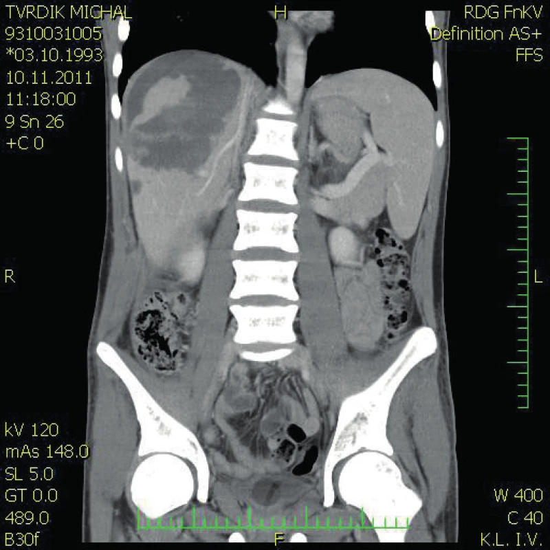 CT břicha s nálezem poranění jater 4. stupně indikované k damage control operaci