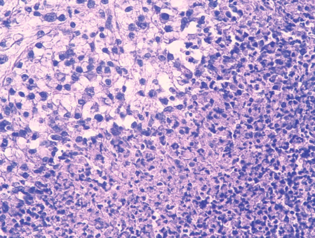 Histologický obraz kožnej metastázy – hemoragicko-nekrotické ložisko v tumore (hematoxylín-eozín, 400x).