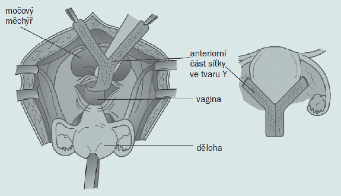 Při hysterokolposakropexi je podél anteriorní části vaginální stěny připevněna síťka ve tvaru ypsilon.