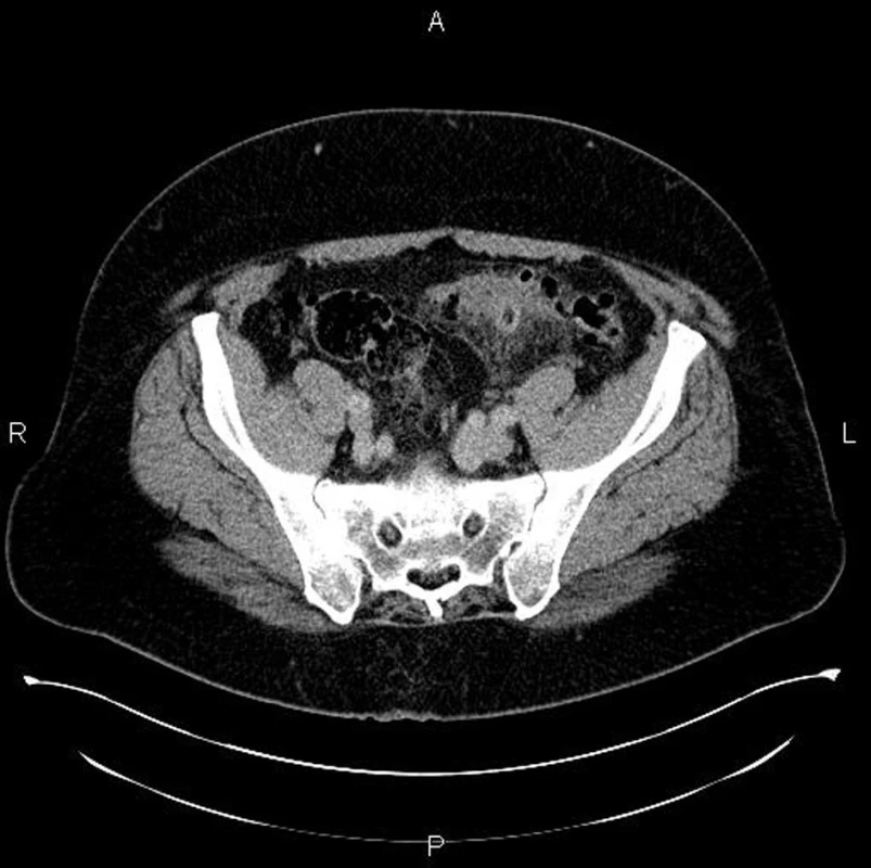 CT vyšetření: obraz akutní divertikulitidy na sigmatu s infiltrací přilehlého tuku