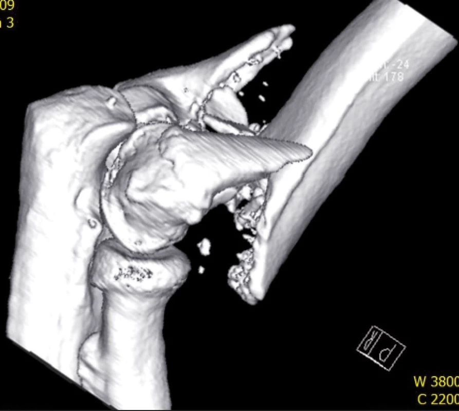 CT vyšetření - 3D rekonstrukce zlomeniny distálního humeru v bočné projekci