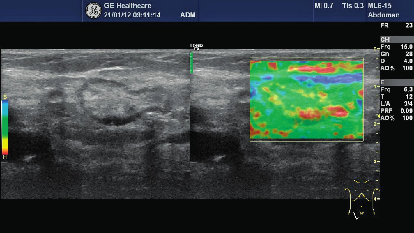 Obr. 3 Strain elastografie – obraz benigní intraabdominální uzliny u 78letého pacienta, je patrný minimální výskyt tuhých okrsků (převaha zelené barvy, minimum červené, elastografické skóre 1–2)