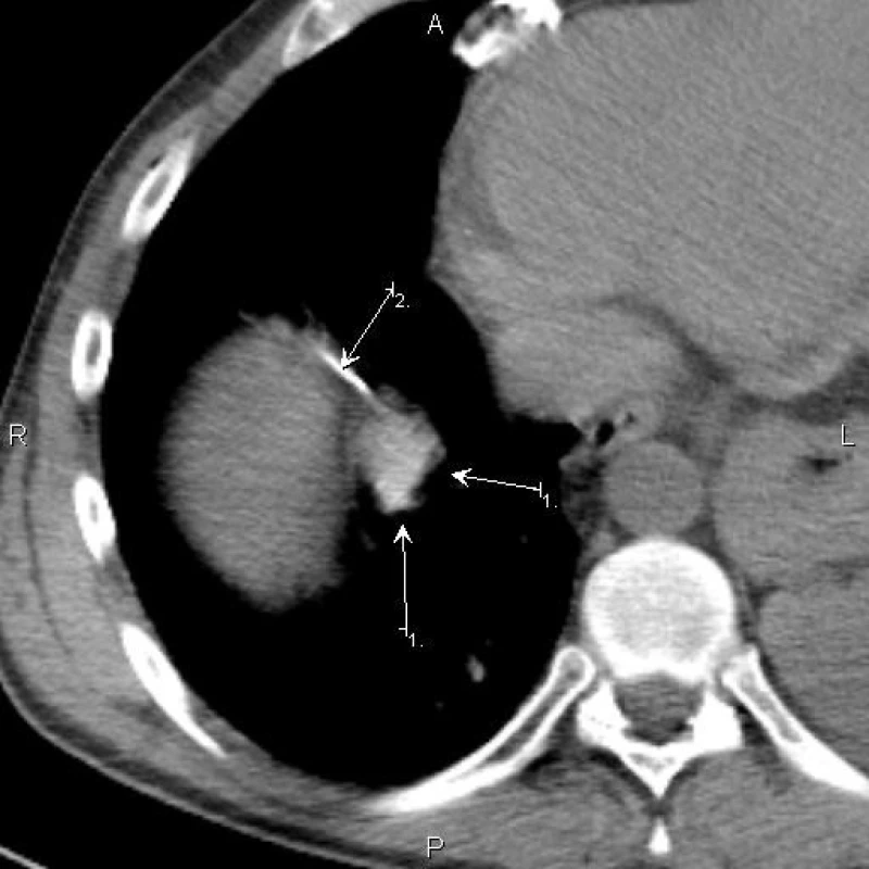 Viabilní ložisko podle PET/CT (šipka 1) s jehlou (šipka 2) tangenciálně probíhající nad bránicí a srdcem Intrapulmonální relaps lymfomu.