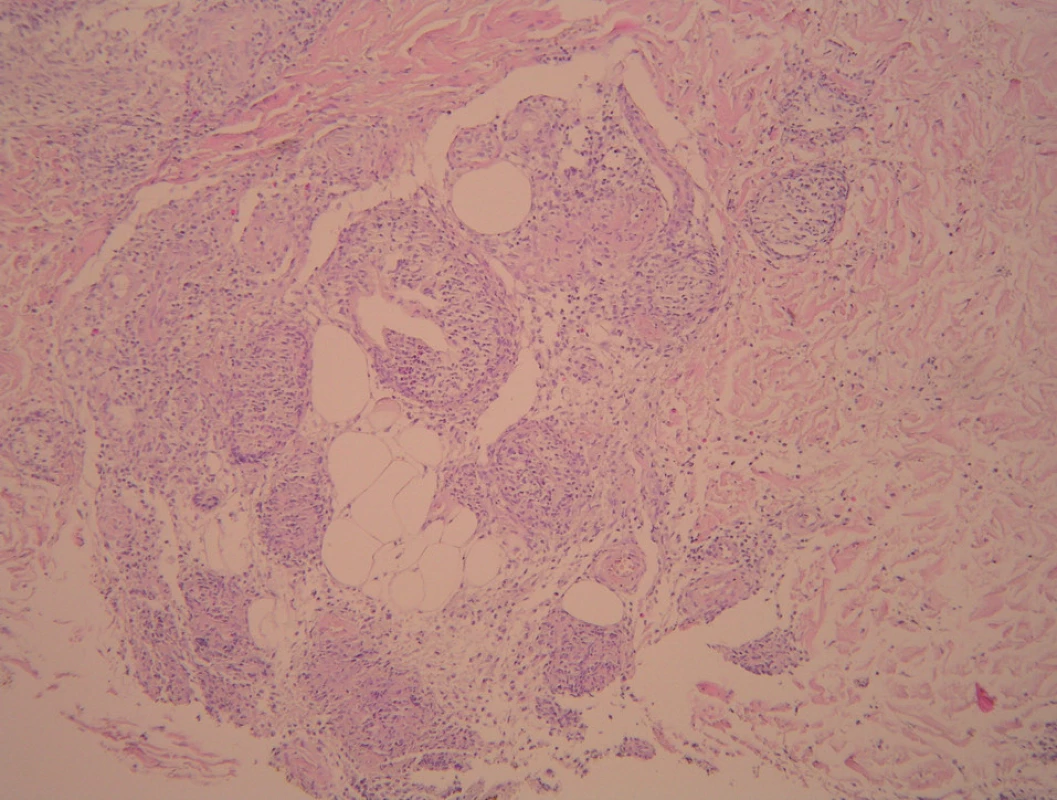 V dolním koriu při subcutis jsou četné granulomatózní uzlíky sarkoidálního typu navíc s extravazálními erytrocyty s nečetnými fragmenty polynukleárů a menšími infiltráty lymfocytů (HE, zvětš. 200x).