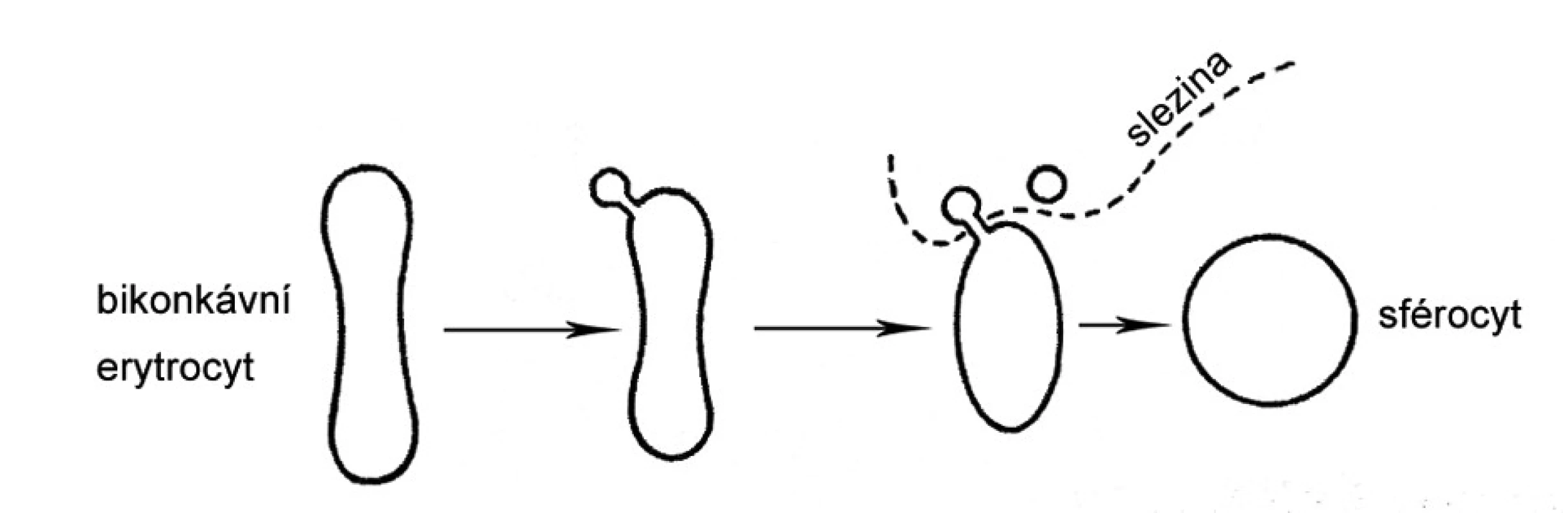 Schéma vzniku sférocytu.