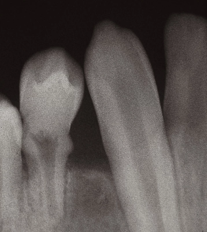 Intraorální rentgenový snímek, zub 44 s anomálním tvarem klinické korunky, hypoplastickými změnami v krčkové krajině a krátkým radixem