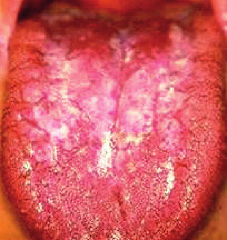 Škvrnitá leukoplakia na povrchu jazyka. Olupovanie keratotických plátov je v oblasti koreňa jazyka. V prednej časti tela jazyka je homogenná hyperkeratóza (Ďurovič)
