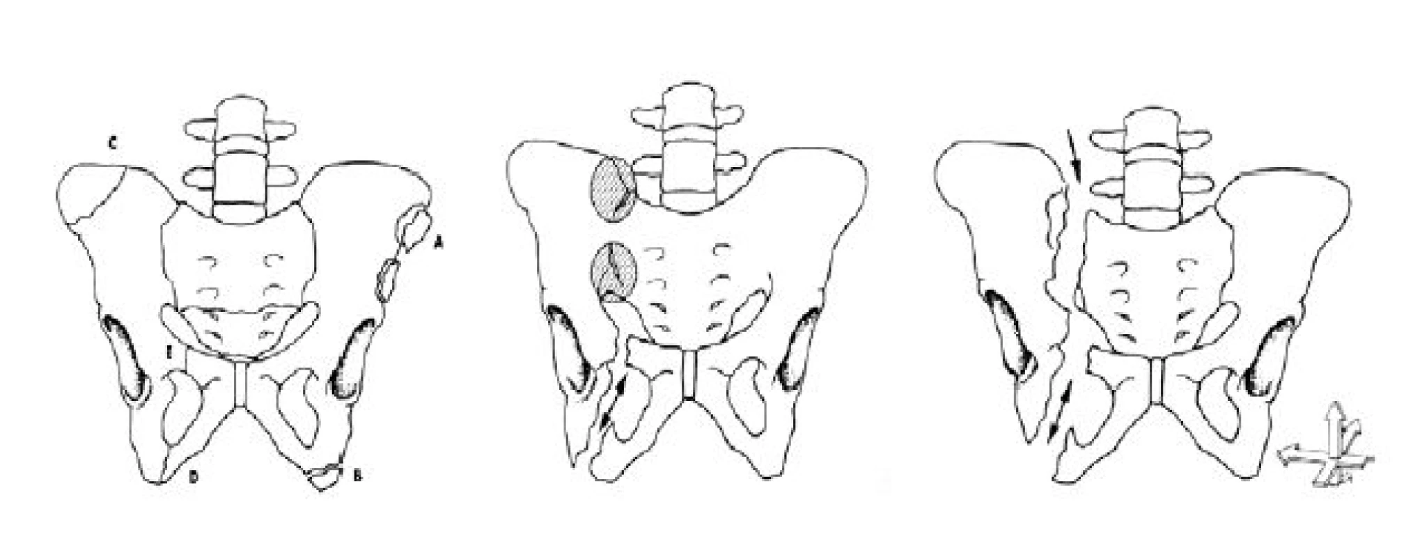 Fraktury pánve: dělení dle AO – typ A, B a C
Fig. 1. Pelvic fractures: division by AO – type A, B, C