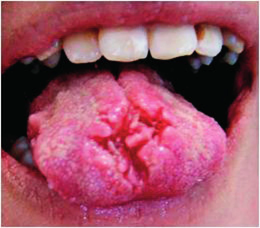 Linqua plicata. Hlboké trhliny sú prítomné na hrote a trla jazyka. V týchto miestach často vznikajú druhotné povrchové zápaly (Vodrážka)