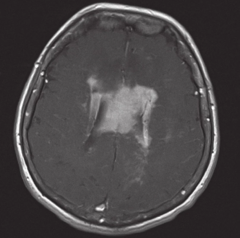 Magnetická rezonance, SE MTC T1 s kontrastní látkou i.v. Pacientka K. A. 1941, transverzální řez, kontrastně se sytící infiltrát lymfomu v corpus callosum a periventrikulárně, hyposignální vazogenní edém v okolí.