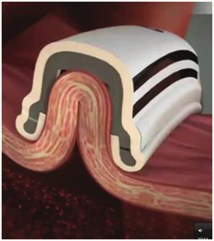 Průřez ablačním katétrem; myokard síně je nasán podtlakem do nitra sondy, mezi ablační elektrody
Fig. 2: Cross-section of the catheter; the atrial wall is sucked into the catheter, between the ablation electrodes