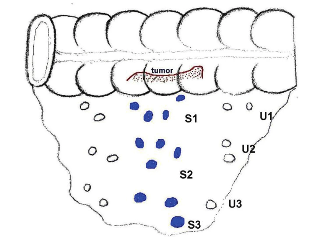Schéma detekce SLN podle etáží
Fig. 1. A scheme of sentinel lymph node (SLN) detection in individual levels