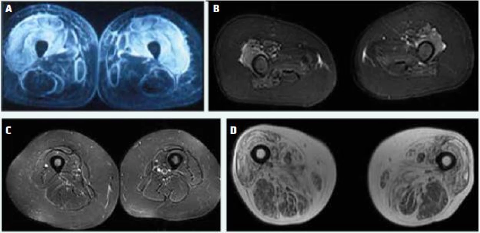 STIR (short tau inversion recovery) MRI (A–C) a T1 vážený obraz (D) stehenních svalů. (A) zánětlivý edém extenzorů a tekutina ve fasciálních prostorech u pacientky s aktivní dermatomyozitidou, bez známek svalové atrofie (B) lokalizovaný edém svalů v oblasti extenzorů kolene u pacientky s dlouho trvajícím aktivním onemocněním a těžkou svalovou atrofií (C) bez známek edému (zánětu) na MRI u pacientky s polymyozitidou a přetrvávající svalovou slabostí kvůli svalové atrofii (D) tuková infiltrace a atrofie u pacienta s myozitidou s inkluzními tělísky