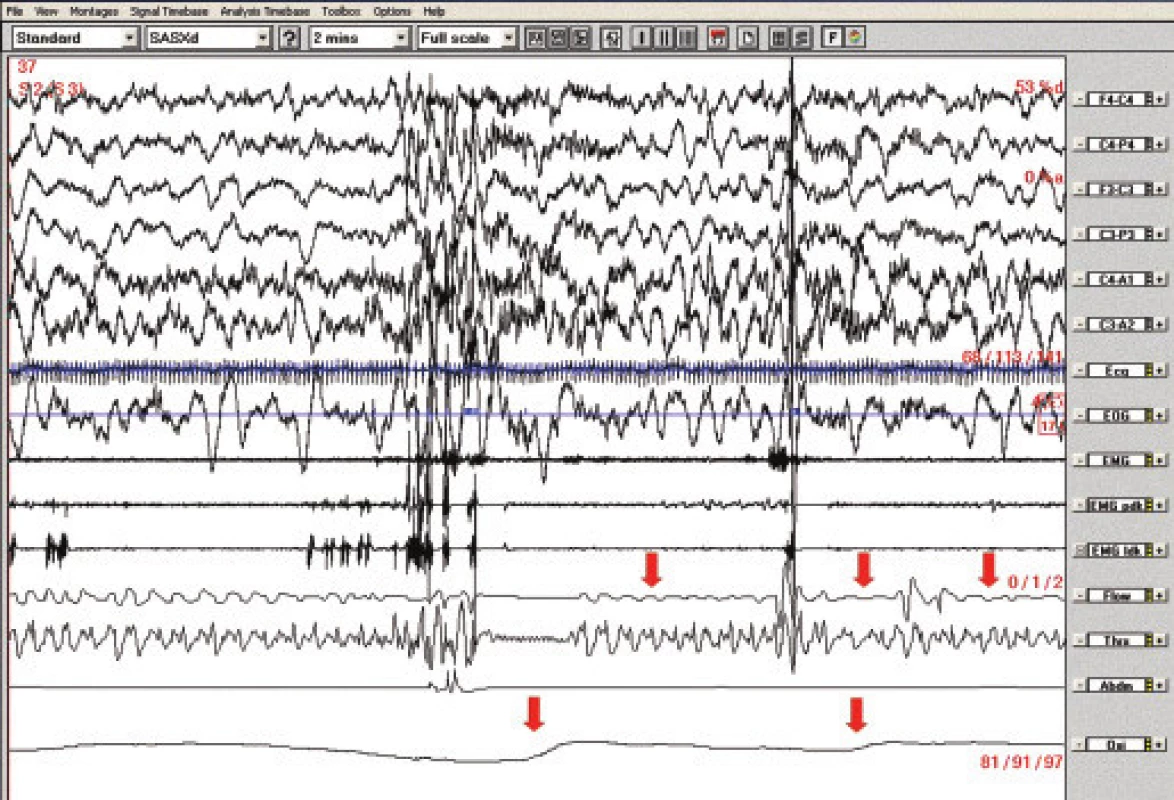 Polysomnografický záznam (2minutový úsek), pacientka č. 2. Obstrukční apnoe v NREM 2 spánku spojené s poklesy saturace hemoglobinu kyslíkem (označeno šipkami). 