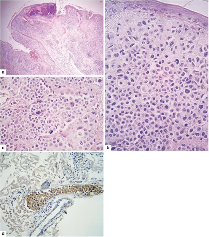 Névoidní melanom
a – exofytický nodulus bez pigmentu
b – povrchní část s monotónními melanocyty imitujícími vyzrávání (zmenšování jader směrem do hloubky)
c – v jiném zorném poli je patrný určitý pleomorfismus jader a prominující jadérka některých melanocytů 
d – v dolním okraji řezu jsou tyto HMB-45 pozitivní melanocyty v cévě a tumor tedy projevuje intravaskulární propagaci