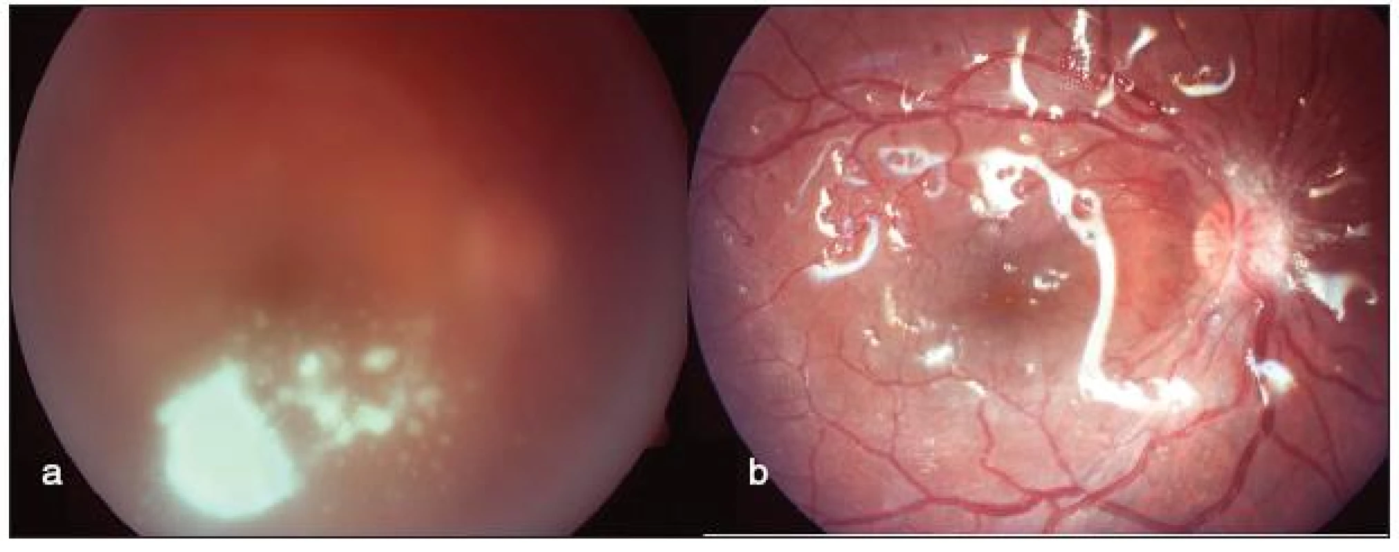 Endogenní mykotická endoftalmitida u pacientky s ulcerózní kolitidou (a). Nález na očním pozadí po provedení diagnosticko-terapeutické PPV s vnitřní tamponádou silikonovým olejem (b)