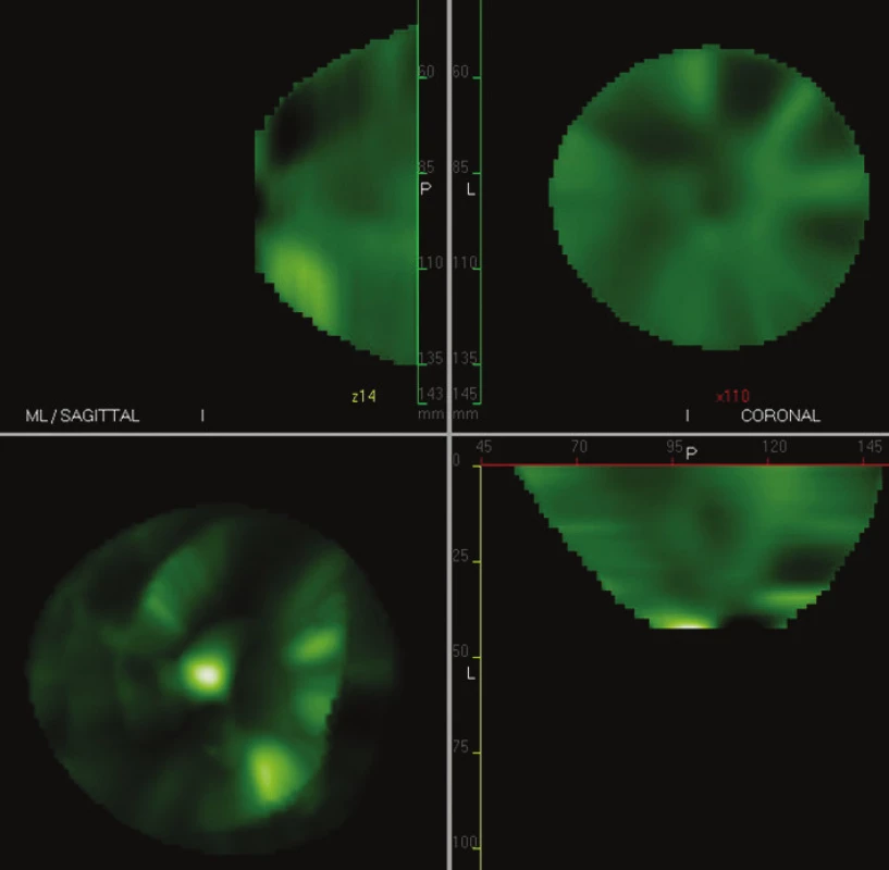 CTLM skeny – tři základní roviny v 2D zobrazení a vlevo dole 3D zobrazení, normální nález při CTLM vyšetření
