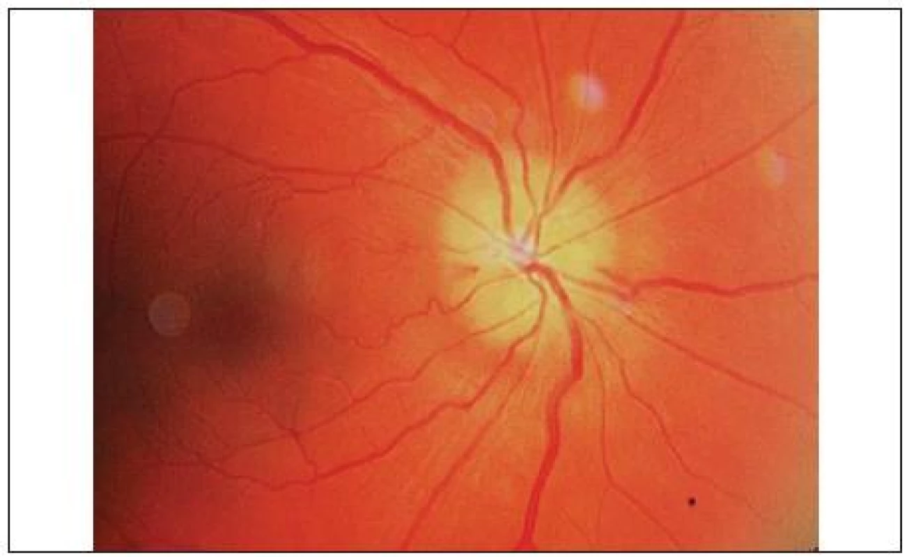 Edém papily zrakového nervu vpravo, najmä v dolnej časti, prekrývajúci oftalmoskopicky viditeľné drúzy