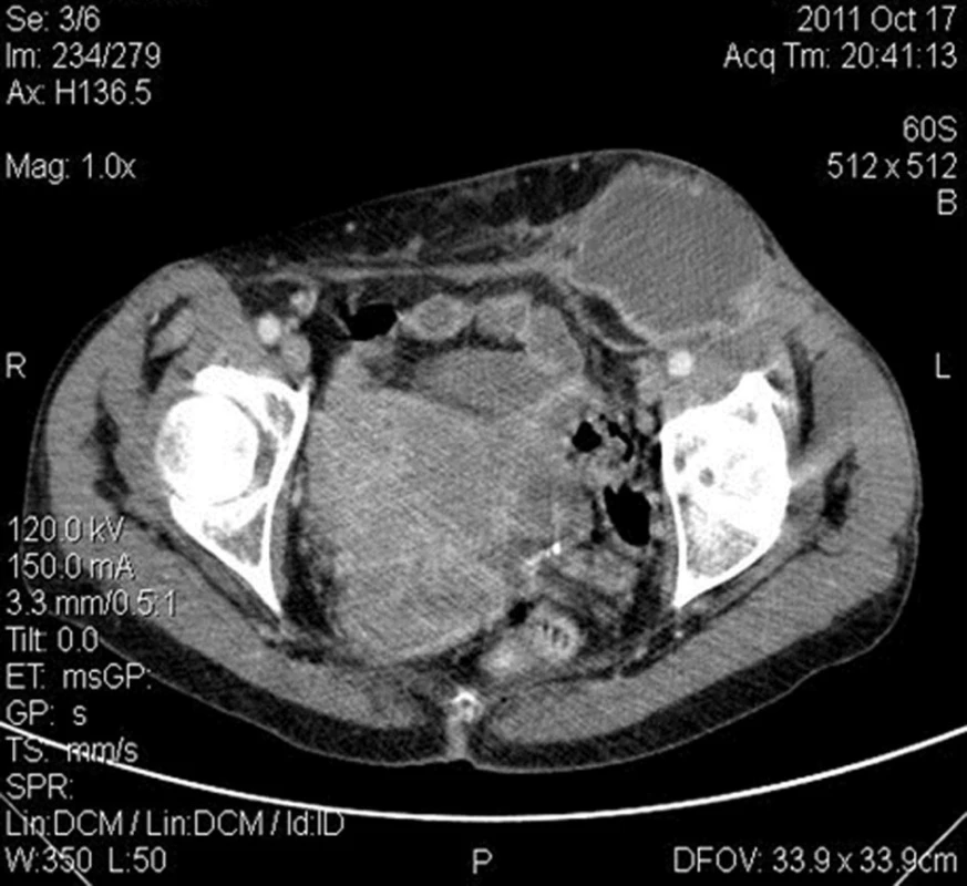 CT obraz abscesu v L třísle bez komunikace s dutinou břišní
Fig. 2: CT image of the left groin abscess without communication with the abdominal cavity