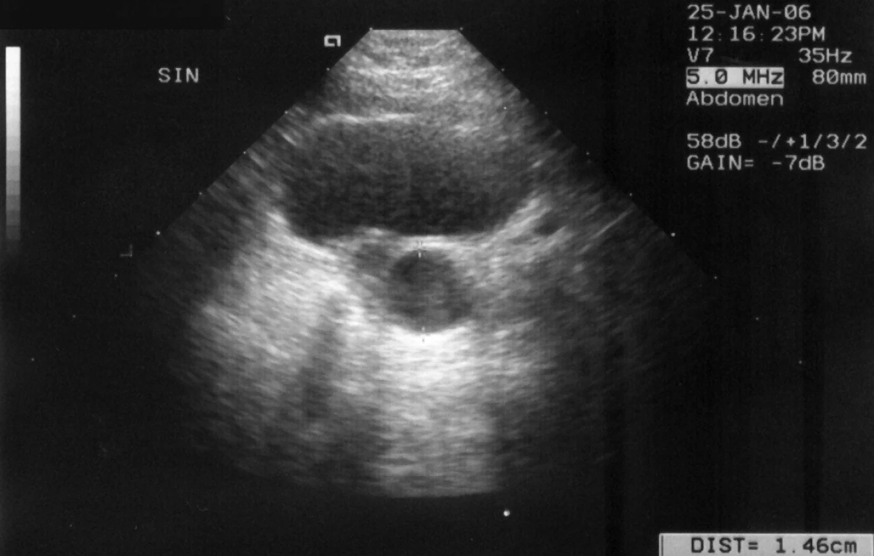 Kazuistika č. 3. UZ zobrazení močového měchýře a dilatovaného vinutého ureteru v distálním úseku šíře 14,6 mm.
Fig. 6. Case report 3. US image of urinary bladder and dilated wind ureter in distal segment of 14.6 mm width.