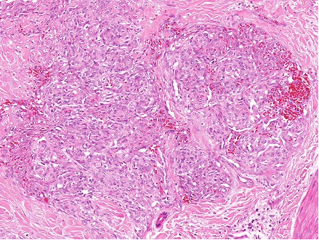 Histologický obraz tufted hemangiomu: typické uspořádání kapilár do okrouhlých ložisek