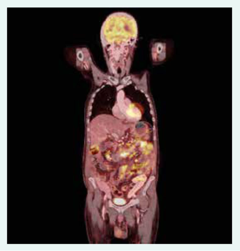 1. PET/CT koronární řez. Akumulace
radiofarmaka v tenkých kličkách, tračníku
a metabolicky aktivní uzliny v retroperitoneu,
mezenteriu a mediastinu. Z archivu autorky