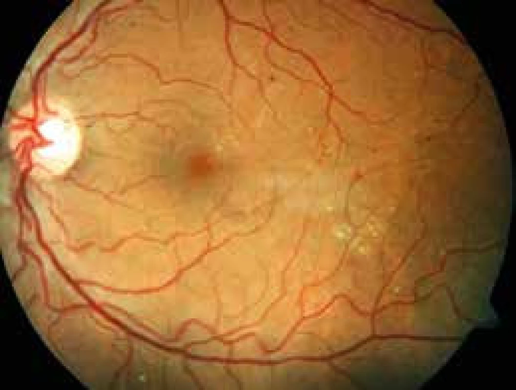 Neproliferativní forma diabetické retinopatie