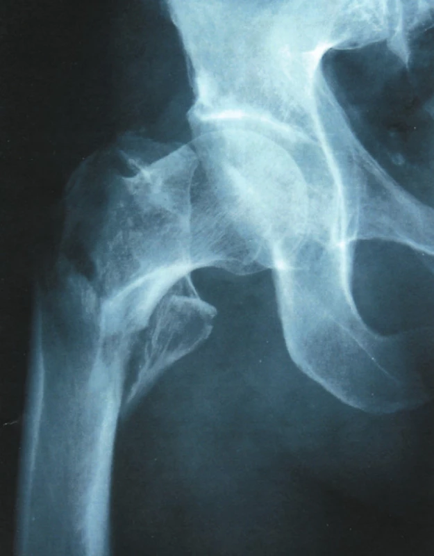 Vícefragmentová pertrochanterická zlomenina stehenní kosti; častá zlomenina u seniorů
Fig. 3. Amultifragmented pertrochanteric femoral fracture; a common fracture in the elderly