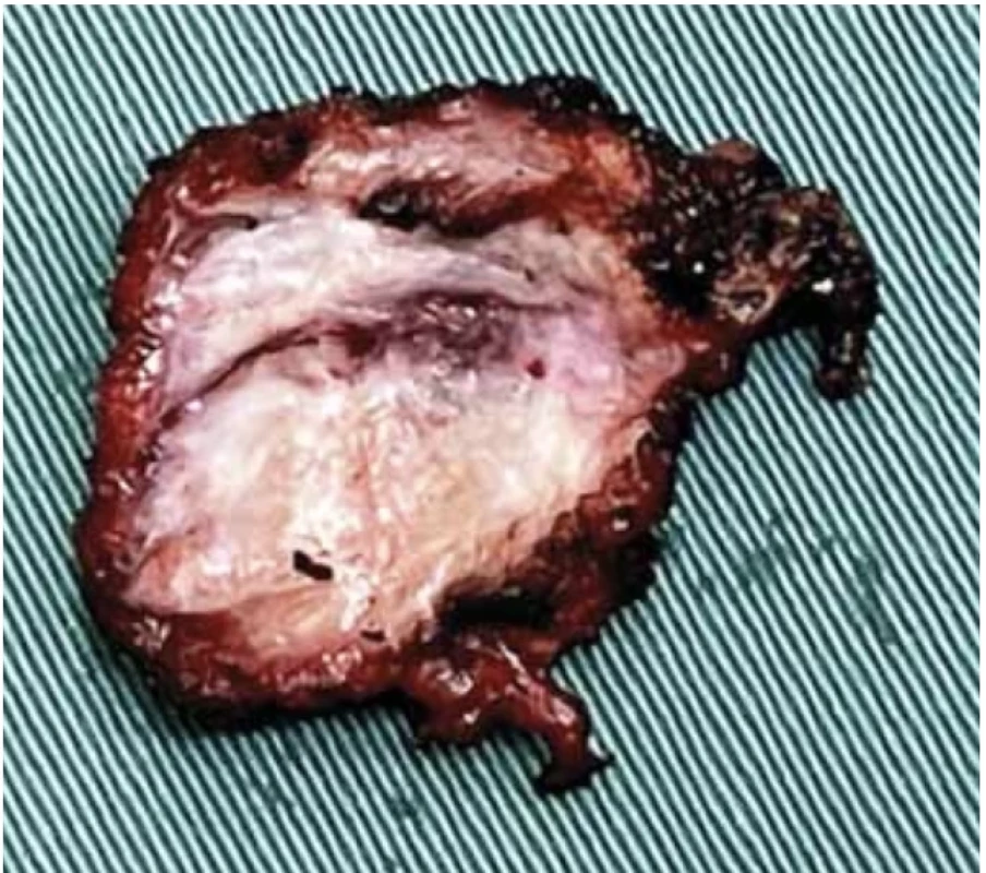 Cutaway image of the nodule. // Výřezový obraz uzliny.