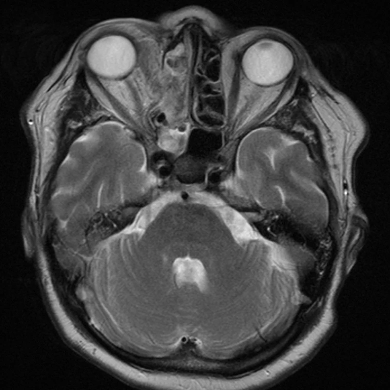 MR, axiální řez, 1. pooperační den – tumor je kompletně odstraněn