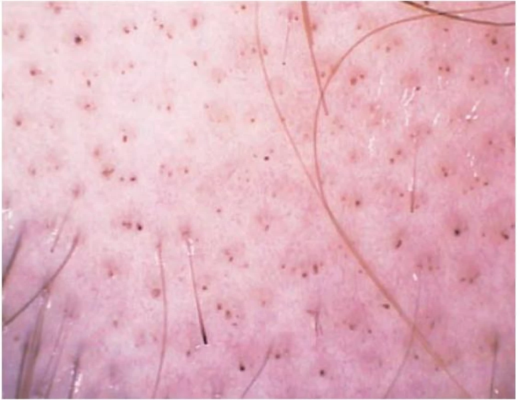 Areátní alopecie – mnohočetné black dots