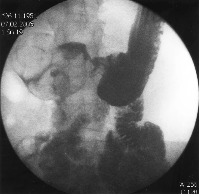 RTG kontrastní vyšetření zobrazující intraluminálně uložený objemný tumor duodena.
Pic. 1. Duodenography showing a large intraluminal tumour