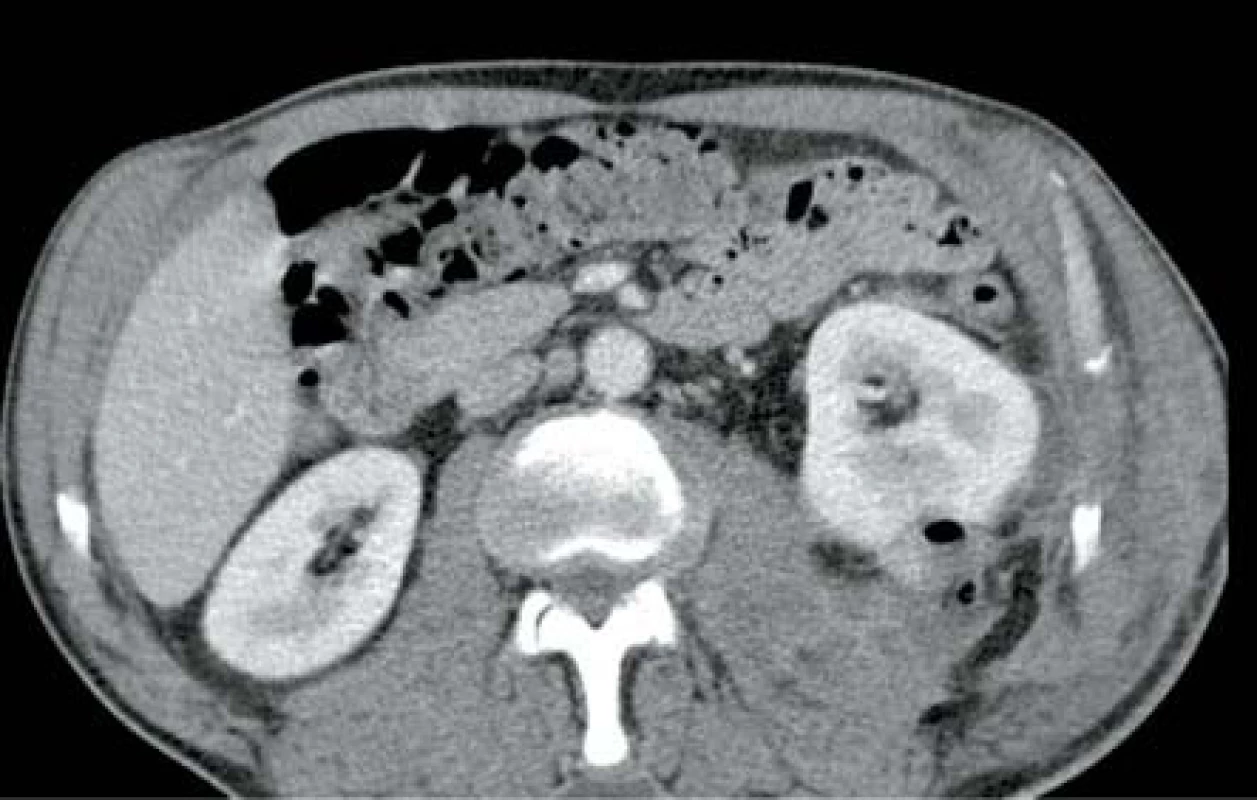 Drobný ledvinný absces levé ledviny s ložiskem plynu
Fig. 6. Slight abscess in left kidney with gas deposit