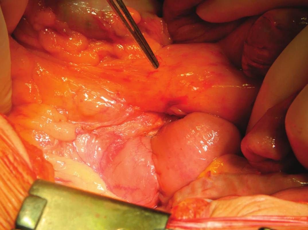 Anastomóza duodenojejunální, retromezenterická, dvouvrstevná
Fig. 2: Duodenojejunal anastomosis, continual suture, two-layer, retromesenteric aproach