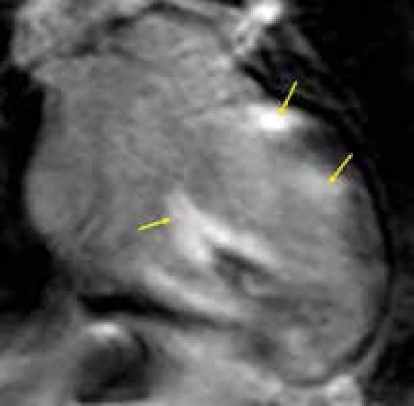 Ložiska transmurálního pozdního sycení kontrastní látkou (LGE) v bazálních segmentech septa komor a bočné stěny levé komory, a anterolaterálním papilárním svalu (žluté šipky) u nemocného se srdeční sarkoidózou;
