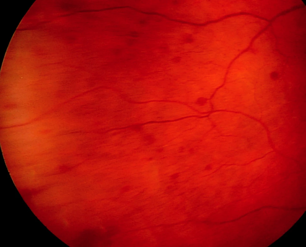 Morbus Waldenström manifestující se v oku 56letého pacienta mnohočetnými retinálními hemoragiemi sítnicové periferie