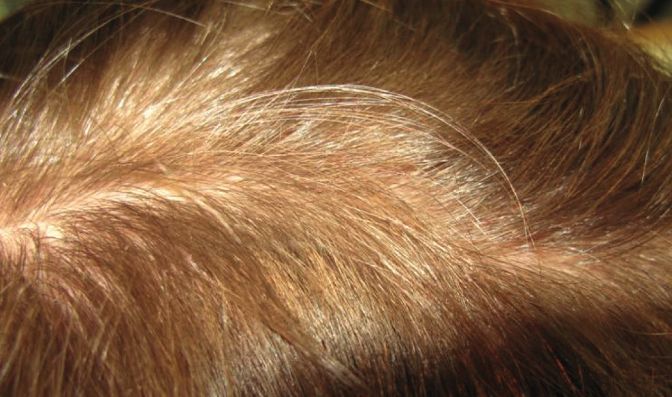 Androgenetická alopecie, Ludwig 1 (mezoterapie vhodná, prognóza dobrá)