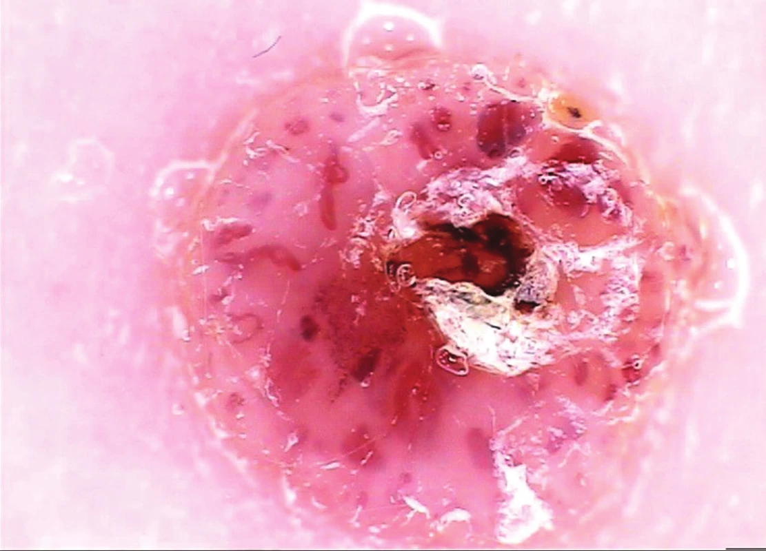 Névus Spitzové atypický – histologicky
Dítě 4 roky, krátká anamnéza trvání (měsíce). Dermatoskopicky dobře ohraničená léze, bez pigmentu, světle růžové pozadí, polymorfní cévní struktury poměrně pravidelně radiálně uspořádané kolem centrální krusty. Dermatoskopický nález vylučuje hemangiom a pyogenní granulom, které přicházejí v úvahu klinicky i s ohledem na věk pacienta, dále není specifický.