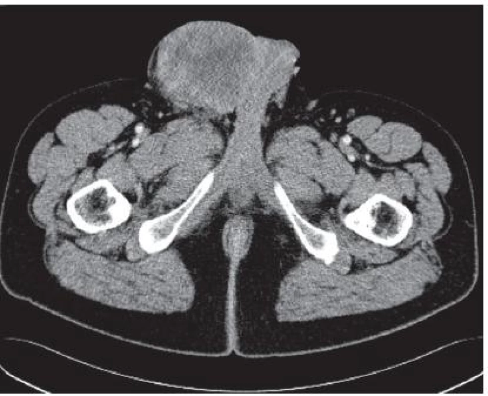 CT snímek prokazující objemnou lokální recidivu a s infi ltrací topořivého tělesa
Fig. 5. CT scan, local progresion of tumor, infi ltration to cavernous body of penis