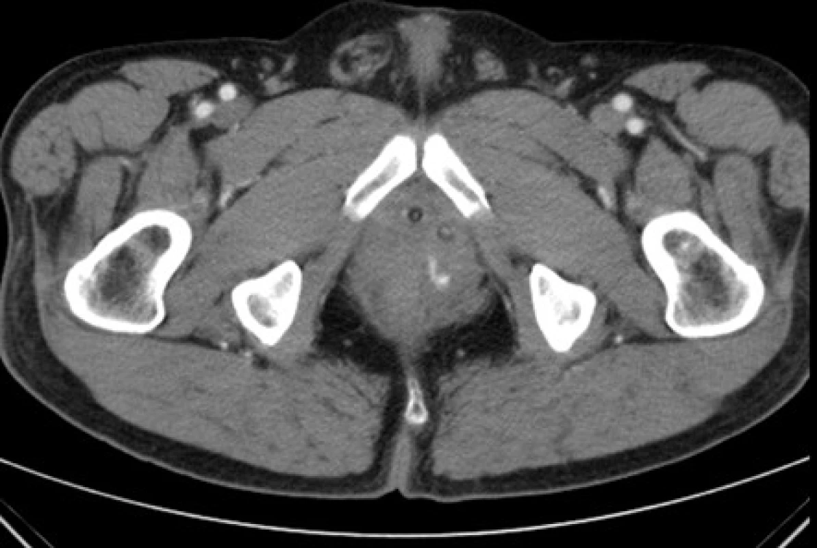 &lt;i&gt;CT – arteriální leak vlevo po prostatektomii – transverzální řez&lt;/i&gt;
Fig. 3. &lt;i&gt;CT scan: arterial leak on left side after the prostatectomy – transverse view&lt;/i&gt;