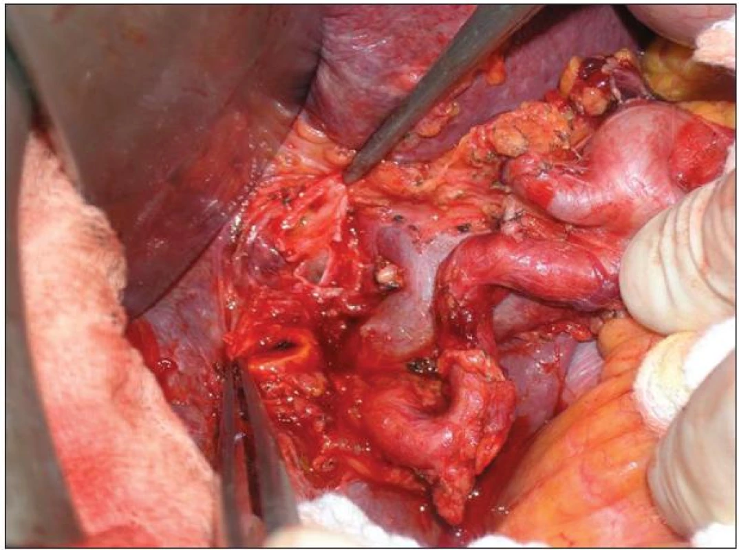 Lymfadenektomie hilu jater a hepatoduodenálního ligamenta v rozsahu N1
Fig. 11: Lymphadenectomy of the liver hilus and hepatoduodenale ligament