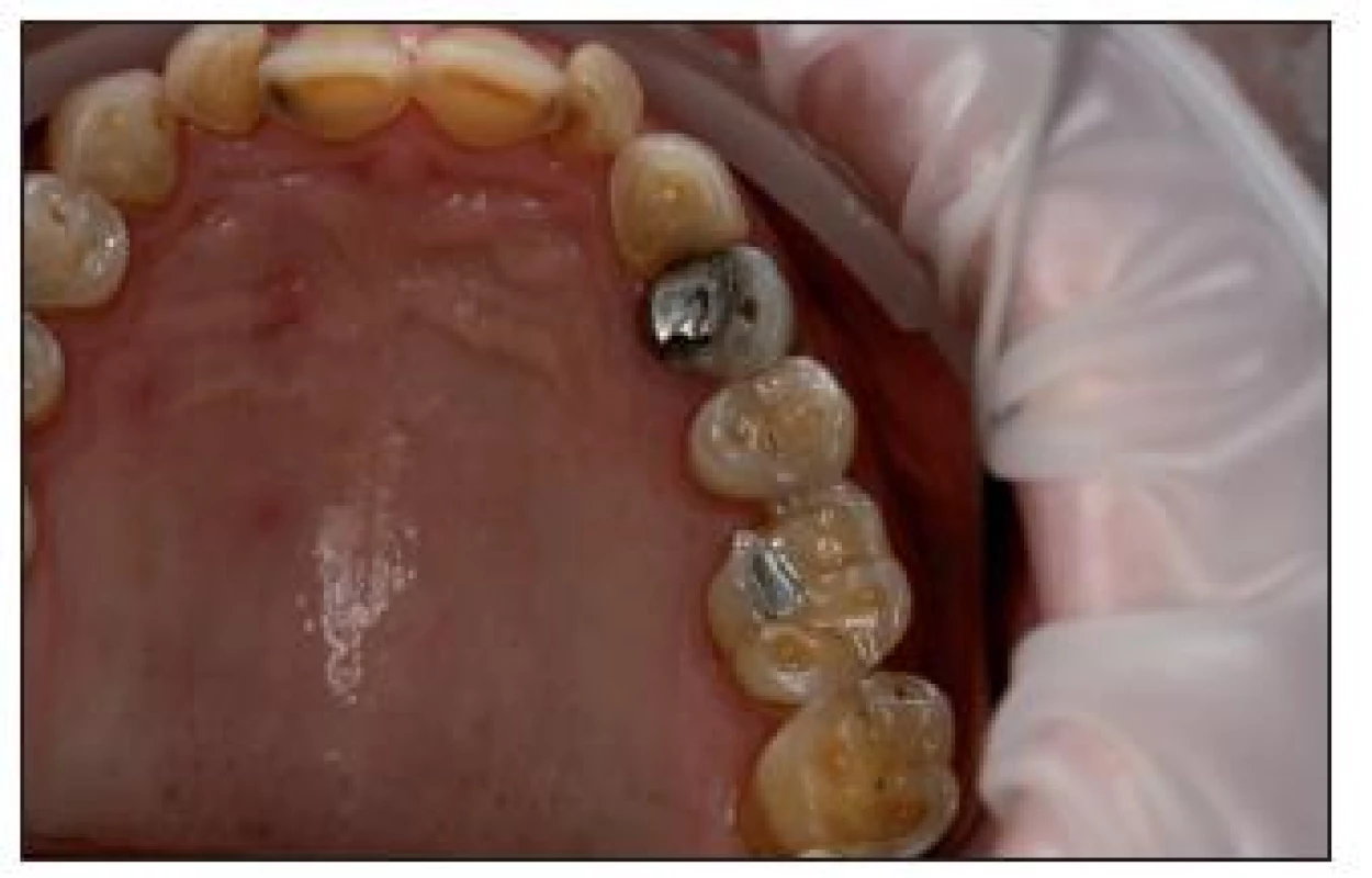 Vážné erozivní defekty na zubech horní čelisti