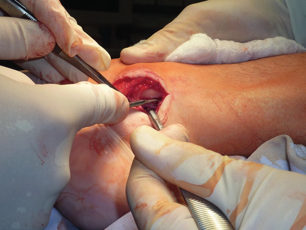 Přímá anatomická reparace resp. reinzerce SPR - vytvoření kostěného žlábku podél posterolaterální hrany fibuly