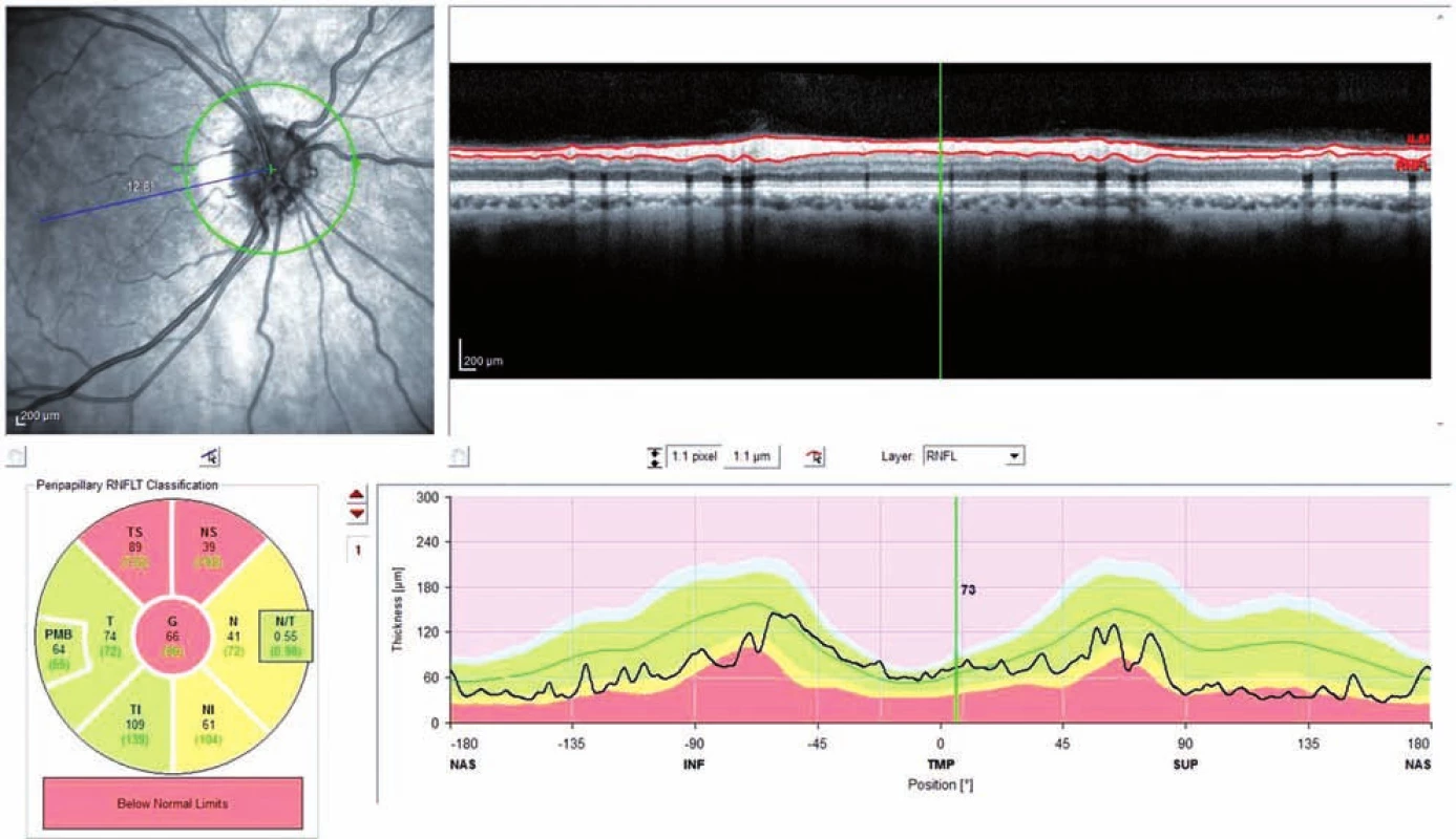OCT RNFL (OCT Spectralis) pravé oko (pacient č. 1).
Pozitívny nález v hornej časti, v nazálnej časti hraničný nález.