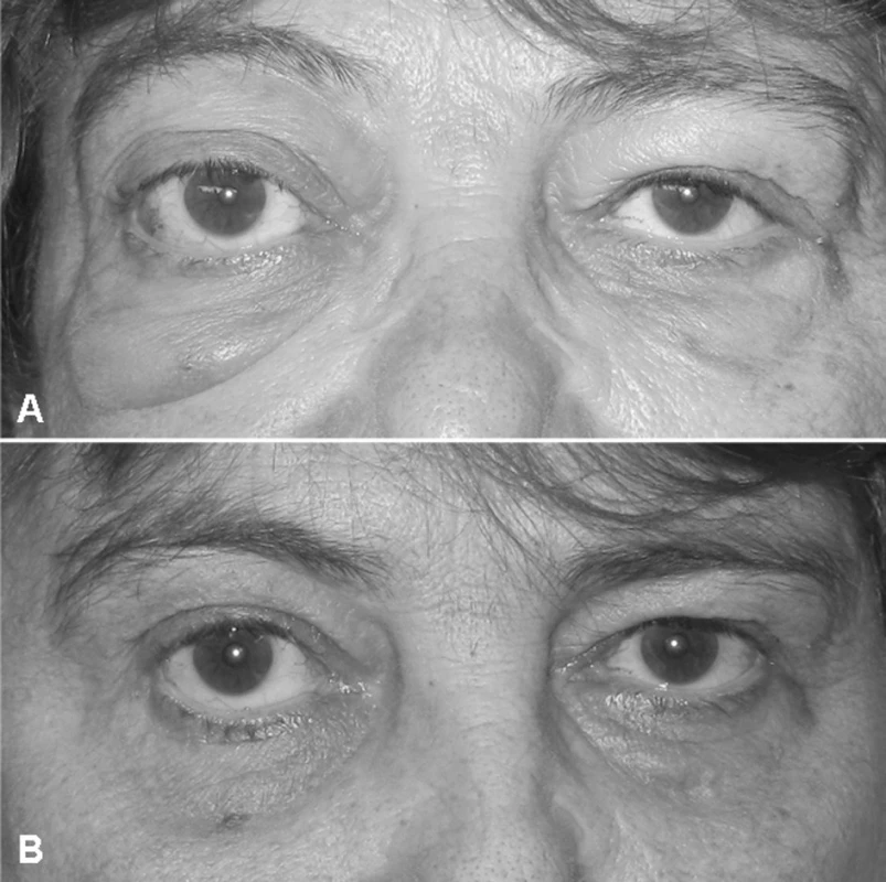 Klinický obraz očních změn: (A) Pravostranný exoftalmus (Hertelův test s rozdílem obou očí 10/100 mm) a zduření pod pravým okem před startem terapie a (B) kontrola za tři měsíce (Hertelův test se stejným nálezem u obou očí).