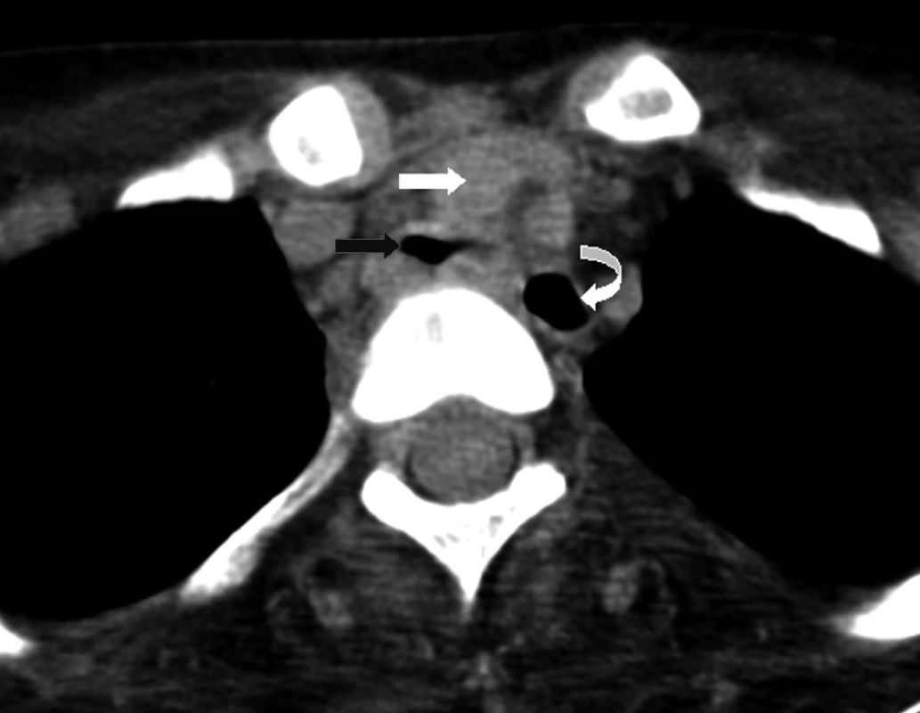 Nativně provedené CT horního mediastina v úrovni odstupů aortálního oblouku
Truncus brachiocephalicus (bílá šipka), trachea (černá šipka) a jícen (zahnutá šipka) v červnu 2007