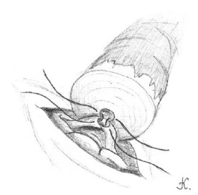 Přiblížení slizniční vrstvy chámovodu k lumen kanálku nadvarlete pomocí 10-0 nylonových stehů se dvěma jehlami, jež jsou umístěny po jeho obou stranách
Fig. 5. The approximation of the mucosal layer of vas deferens and the single epididymal tubule lumen with 10-0 nylon sutures with two needles, which are located on either side