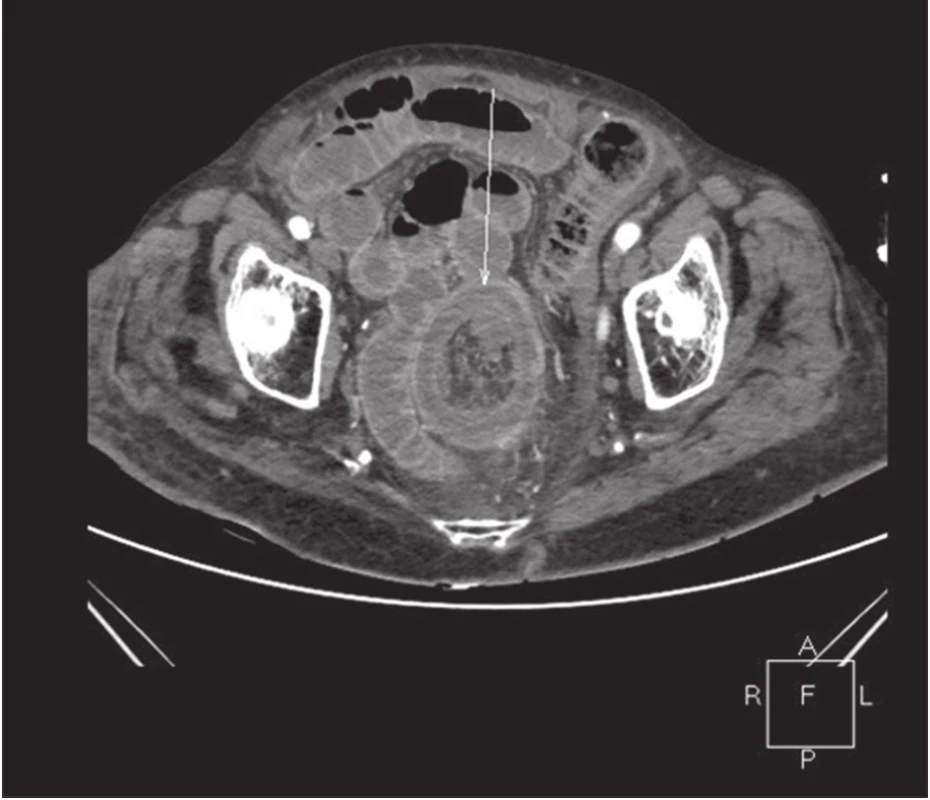 CT obraz invaginace v oblasti colon sigmoidei axiální řez
Fig. 2: CT image of invagination in the sigmoid colon area, axial section