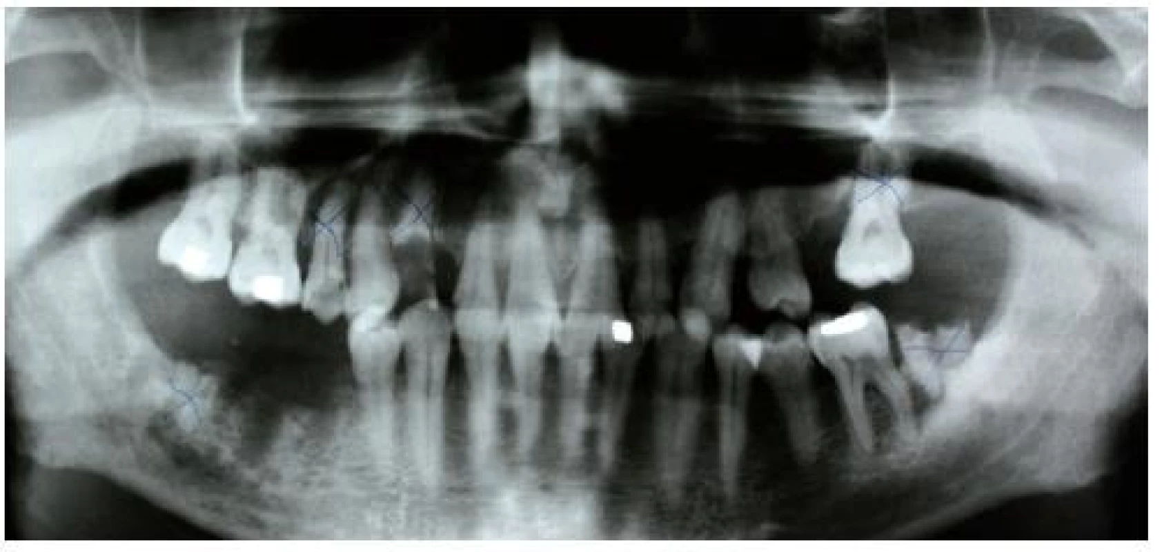 Ortopantomogram pacienta po extrakcích příčinných zubů (47, 46, 45) a označenými gangrenózními zuby určenými k extrakci